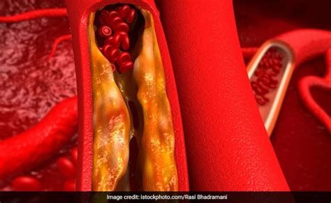 लो एचडीएल कोलेस्ट्रॉल से हार्ट अटैक और स्ट्रोक का खतरा ज्यादा, डॉक्टर ...