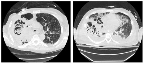 Necrotizing Pneumonia as a Complication of Community-Acquired Pneumonia ...