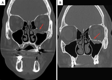 Orbital Floor Fracture Xray