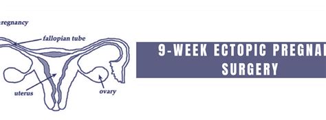 9-Week Ectopic Pregnancy Surgery - Causes and Treatment