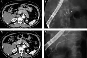 ~Liver is enlarged and diffusely echogenic | diffusely heterogeneous ...