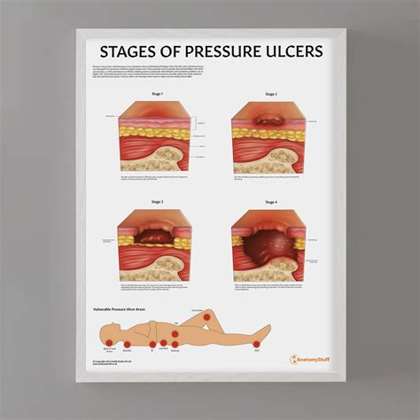 Pressure Ulcer Stages Chart | Bedsore & Decubitus Injury Poster ...