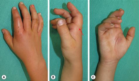 Image result for Finger Dislocation Reduction