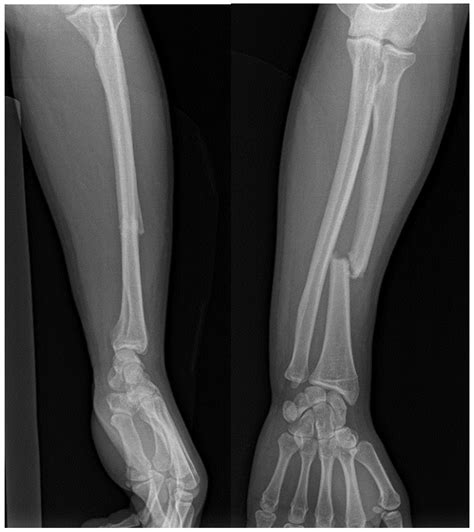 Advancements in Diagnosis and Management of Distal Radioulnar Joint ...