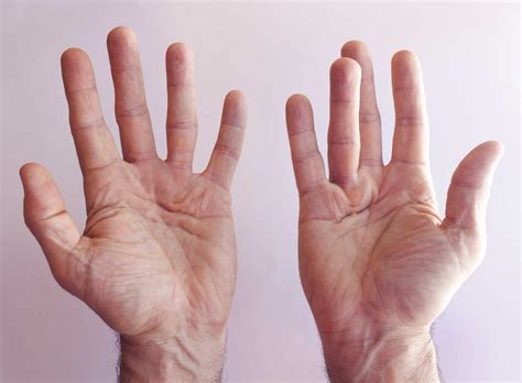 Dupuytren's contracture - Causes, Diagnosis and Treatment
