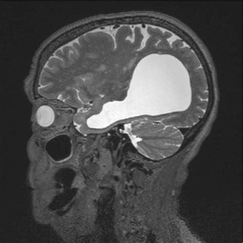 Cavum Veli Interpositi