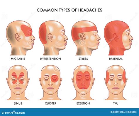 Common types of headaches stock vector. Illustration of depressive ...