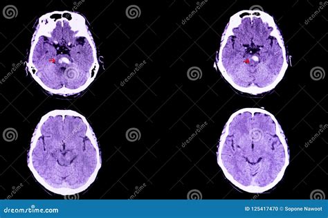 Pontine hemorrhage stock illustration. Illustration of disease - 125417470 - hemorrhage in pons