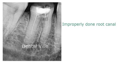 Re-Root canal- A case report