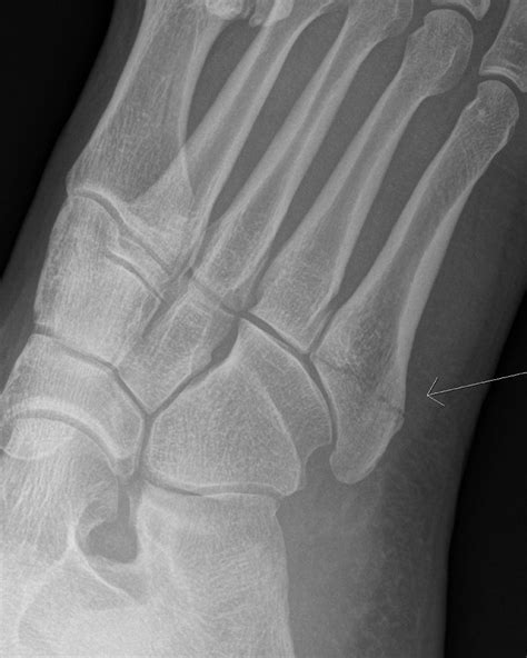 Intra-articular base of 5th metatarsal fractures (Zone 2) – Should we ...