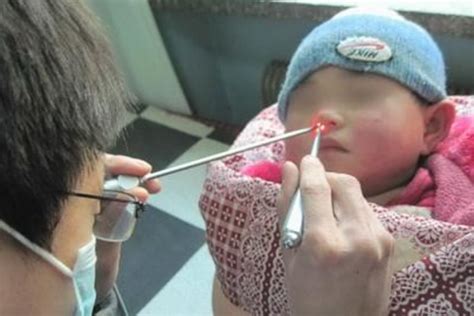 小孩流鼻血是什么原因导致的怎么办急救技巧