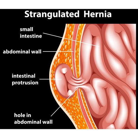 What to Expect Before, During, and After Hernia Surgery