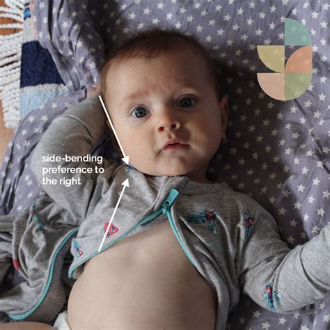 Flat Head Syndrome: When to Worry & What to Do | Growing Bones