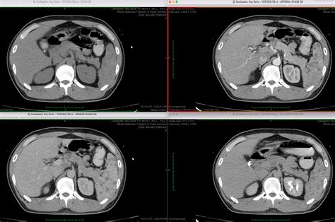 [ROJ-Medical Notes]: Sarcoidosis of the spleen | Problem-based Learning ...