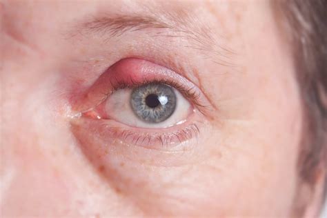Eyelid Redness Causes, Symptoms, Inflamed, Dry Itchy Swollen Red Eyelids, Treatments and ...