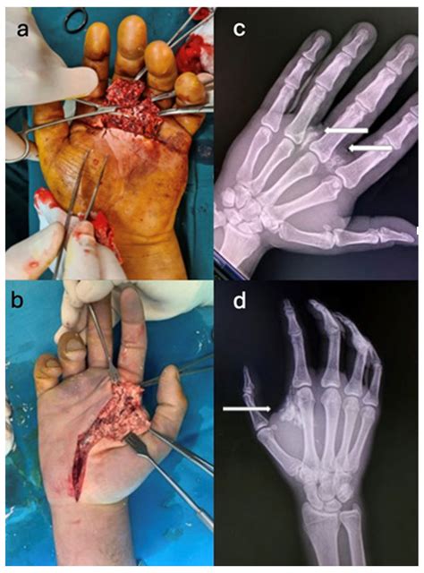 High-Pressure Injection Injury of the Hand—A Rare but True Surgical ...