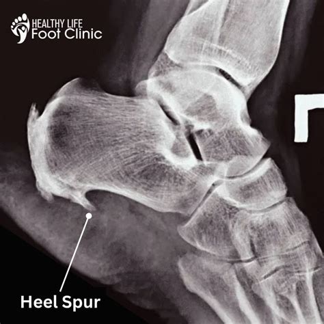 Heel Spurs Explained: Causes, Symptoms & Treatment Options