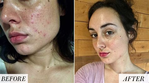 Bloated Face Alcohol