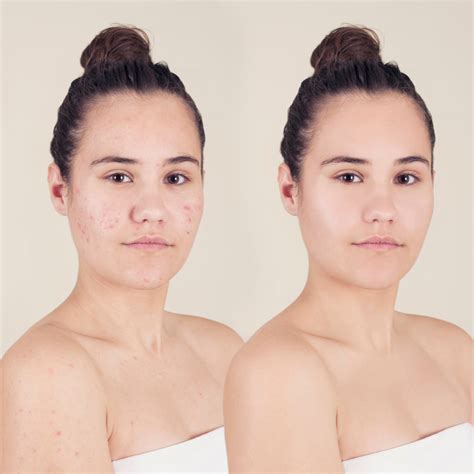 Zobha Acne care Combo