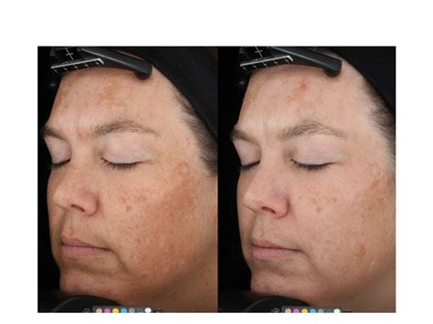 Envy Medical Trifecting Night Cream | LovelySkin