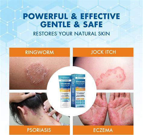 Hermon Antifungal Ringworm Cream - 100ml | Treat Ringworm Jock Itch Eczema & Athlete's Foot for ...