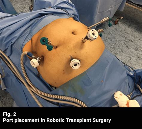 Image result for Robotic Nephrectomy Surgery