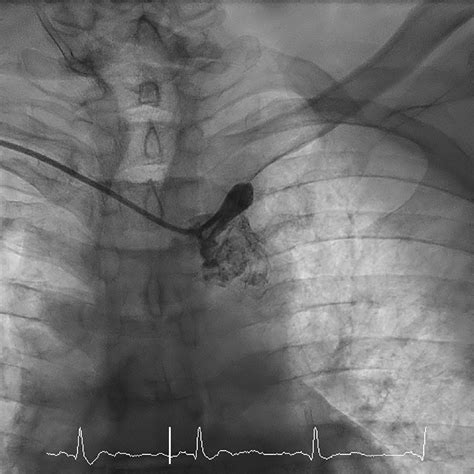 Vertebral Artery Occlusion Blood Pressure at Lorenzo Marrs blog