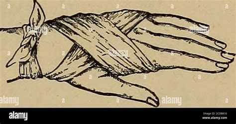 First Using Triangular Bandage 的图像结果