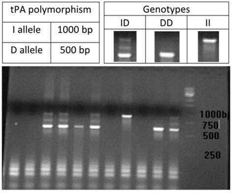Association between Polymorphism eNOS4, tPA, Factor V Leiden ...