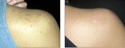 Freckle,Moles Treatment Doctor Hospital Clinic in Gorakhpur Deoria ...