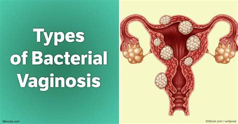 What Are the Types of Bacterial Vaginosis?