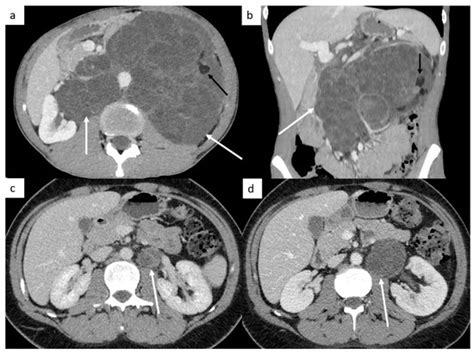 The Role of CT in the Staging and Follow-Up of Testicular Tumors ...