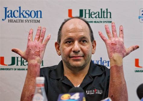 Chef Ralph Pagano released from burn unit | Miami Herald