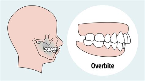 Overbite Correction Techniques | Your Complete Guide