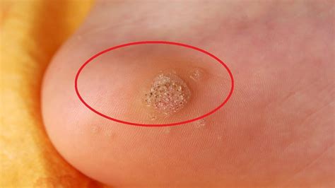 Image result for tea tree oil warts