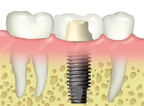 60岁以上老人做种植牙怎么样？60岁种牙好还是活动假牙更好 - 牙科治疗 - 开立特口腔