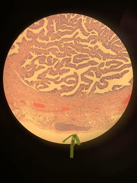 Image result for Fallopian Tube Replacement Surgery