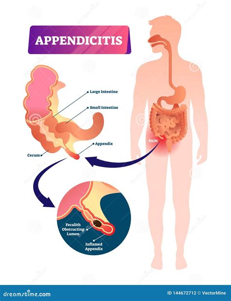 Image result for Appendix Inflammation