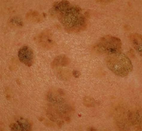 Seborrheic Keratosis - Pictures, Symptoms, Treatment, Removal and Causes | HubPages