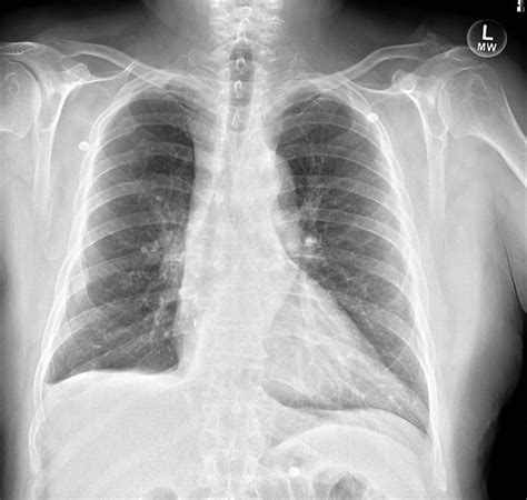Bony Lesions on Chest X-Ray | Chest X-Ray - MedSchool