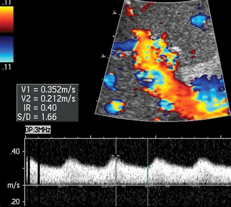 Common Hepatic Artery Ultrasound
