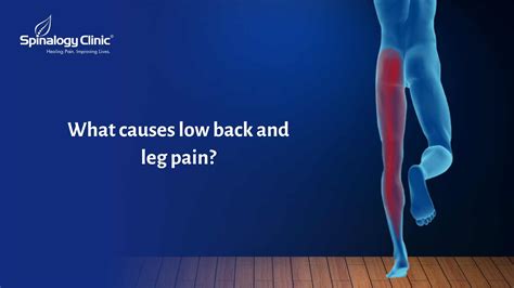 What Causes Low Back and Leg Pain? | Spinalogy Blogs | Best Back Pain ...