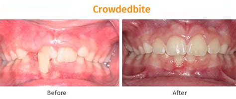 Orthodontist in Ahmedabad, Braces Treatment Cost in Ahmedabad