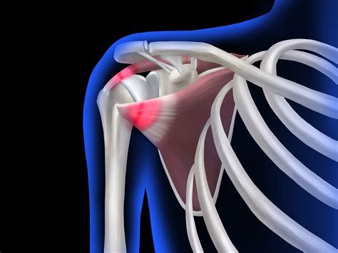 Acromioclavicular joint sprain - Orthopaedic Manipulation