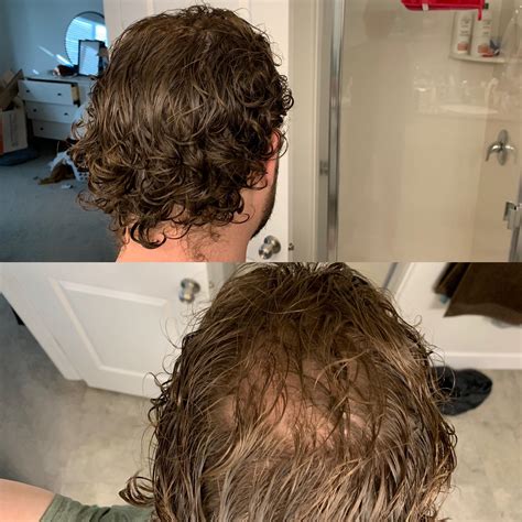 Crown Thinning Hair
