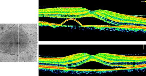 For Central Serous Chorioretinopathy, Wait-and-See No More - Ophthalmology Advisor