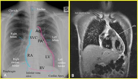 Image result for Chest X-Ray Tutorial