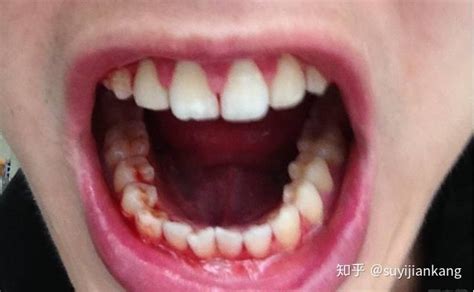 牙龈反复红肿出血，你的牙齿危险了！ - 知乎