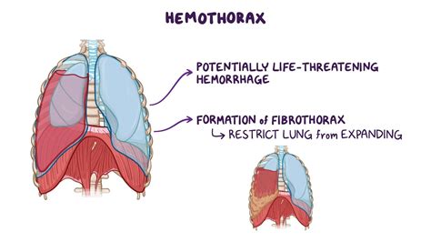 Hemothorax