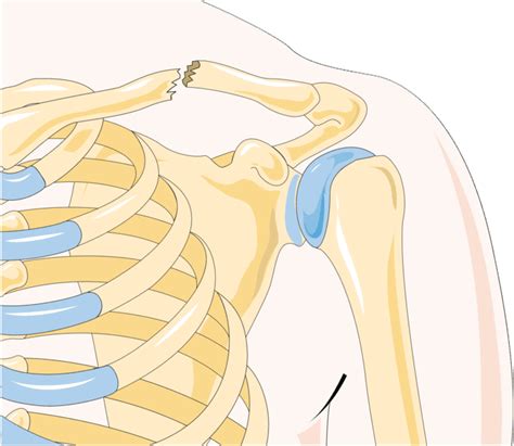 Broken Collarbone (Clavicle): कॉलरबोन टूटना क्या है? जानें इसके कारण ...